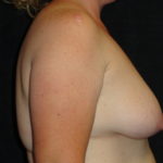 Breast Augmentation #4508 Scottsdale Before And After