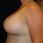 Breast Augmentation #4508 Scottsdale Before And After