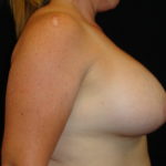 Breast Augmentation #4508 Scottsdale Before And After