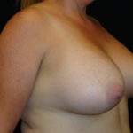 Breast Augmentation #4508 Scottsdale Before And After