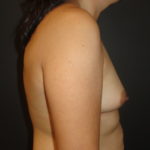 Scottsdale Breast Augmentation Before Photos #4691