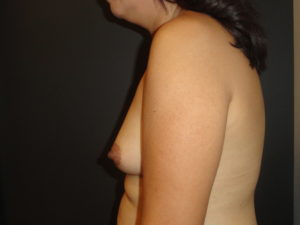 Scottsdale Breast Augmentation Before Photos #4691