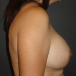 Scottsdale Breast Augmentation After Photos #4691