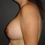 Scottsdale Breast Augmentation After Photos #4691