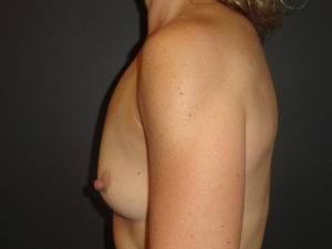Before Devito Plastic Surgery Breast Augmentation #4676 Photos