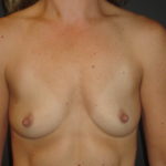 Before Devito Plastic Surgery Breast Augmentation #4676 Photos