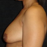 Before Breast Augmentation in Scottsdale Arizona #4479 Photos