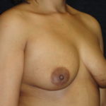 Before Breast Augmentation in Scottsdale Arizona #4479 Photos