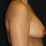 Before Breast Augmentation in Scottsdale Arizona #4479 Photos