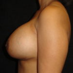 After Breast Augmentation in Scottsdale Arizona #4479 Photos