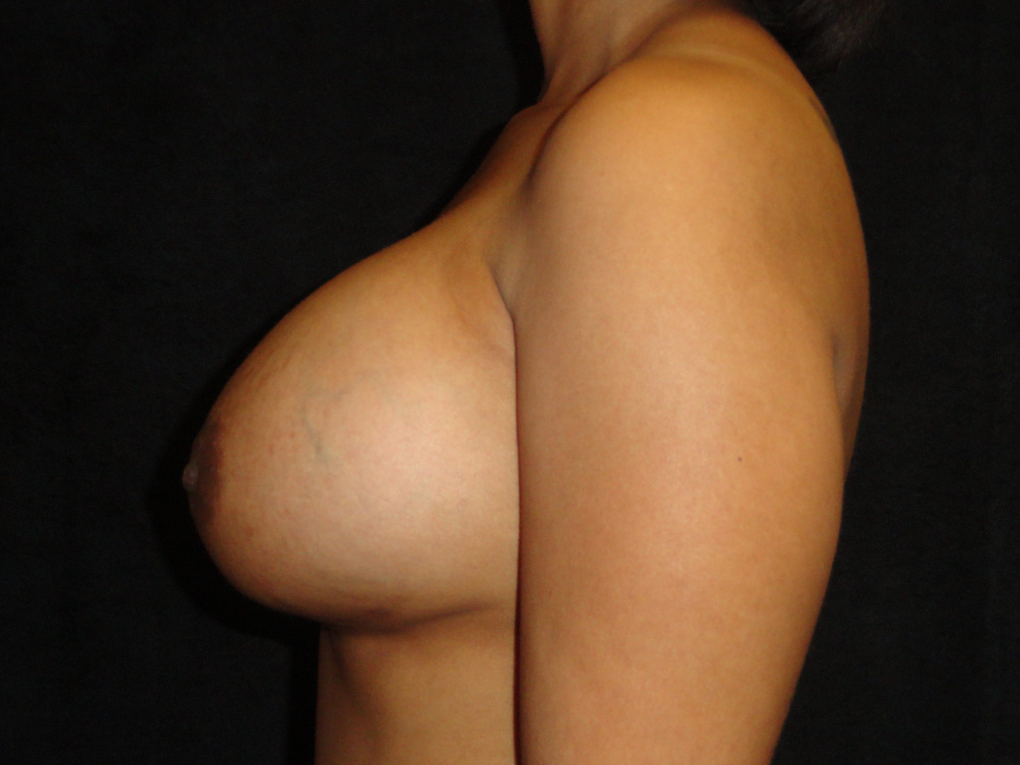 After Breast Augmentation in Scottsdale Arizona #4479 Photos