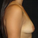 Breast Augmentation Before Photos #3649