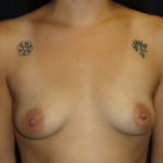 Breast Augmentation Before Photos #3649