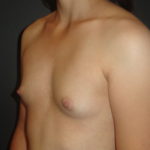 Breast Augmentation Scottsdale Before Photos #4613