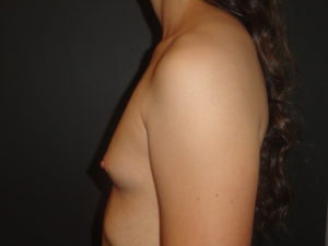 Breast Augmentation Scottsdale Before Photos #4613