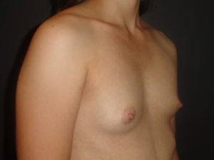 Breast Augmentation Scottsdale Before Photos #4613