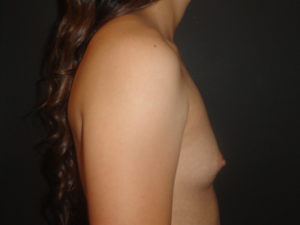 Breast Augmentation Scottsdale Before Photos #4613