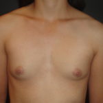 Breast Augmentation Scottsdale Before Photos #4613