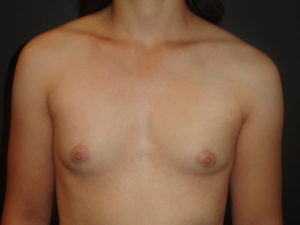 Breast Augmentation Scottsdale Before Photos #4613