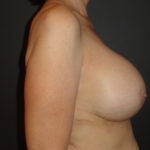 Breast Augmentation Phoenix After Photos #4167