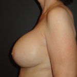 Breast Augmentation Phoenix After Photos #4167