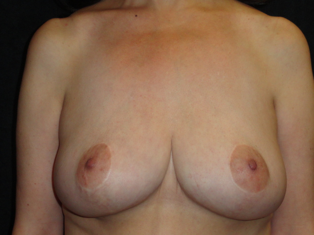 Phoenix Breast Lift After Photos #4277