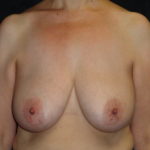 Phoenix Breast Lift Before Photos #4277