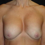 Breast Lift Phoenix Arizona Before Photos #4495