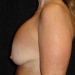 Breast Lift Phoenix Arizona Before Photos #4495