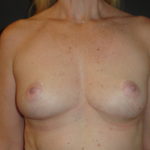 Breast Lift Phoenix Arizona After Photos #4495