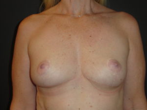 Breast Lift Phoenix Arizona After Photos #4495