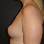 Breast Lift Phoenix Arizona After Photos #4495