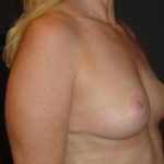 Breast Lift Phoenix Arizona After Photos #4495