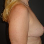 Breast Lift Phoenix Arizona After Photos #4495