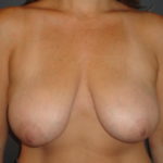 Breast Lift Phoenix Arizona Before Photos #3429