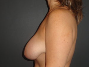 Breast Lift Phoenix Arizona Before Photos #3429