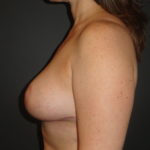 Breast Lift Phoenix Arizona After Photos #3429