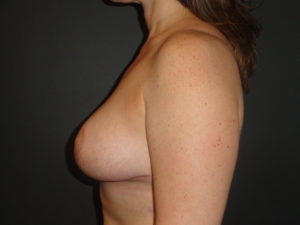 Breast Lift Phoenix Arizona After Photos #3429