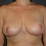 Breast Lift Phoenix Arizona After Photos #3429