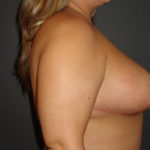 Breast Lift Scottsdale After Photos
