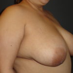 Breast Lift Scottsdale Before Photos
