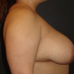 Breast Lift Scottsdale Before Photos