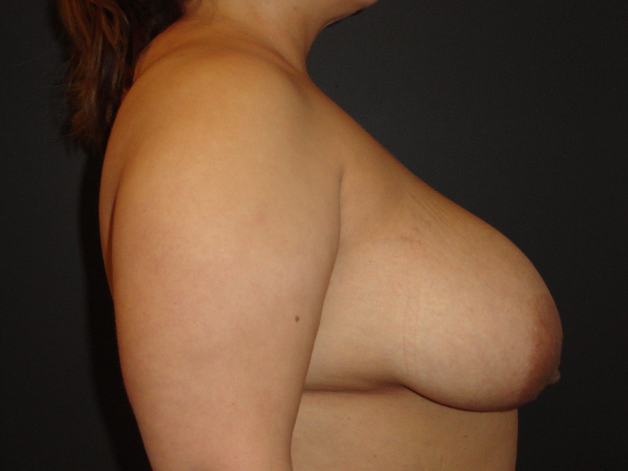 Breast Lift Scottsdale Before Photos