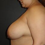 Breast Lift Scottsdale Before Photos