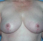 Scottsdale Breast Reduction After Photos Case 2