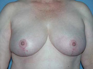 Scottsdale Breast Reduction After Photos Case 2