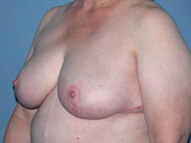 Scottsdale Breast Reduction After Photos Case 2