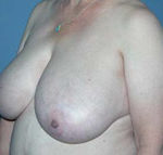 Scottsdale Breast Reduction Before Photos Case 2