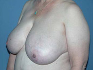 Scottsdale Breast Reduction Before Photos Case 2