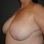 Scottsdale Breast Reduction Before Photos #4715